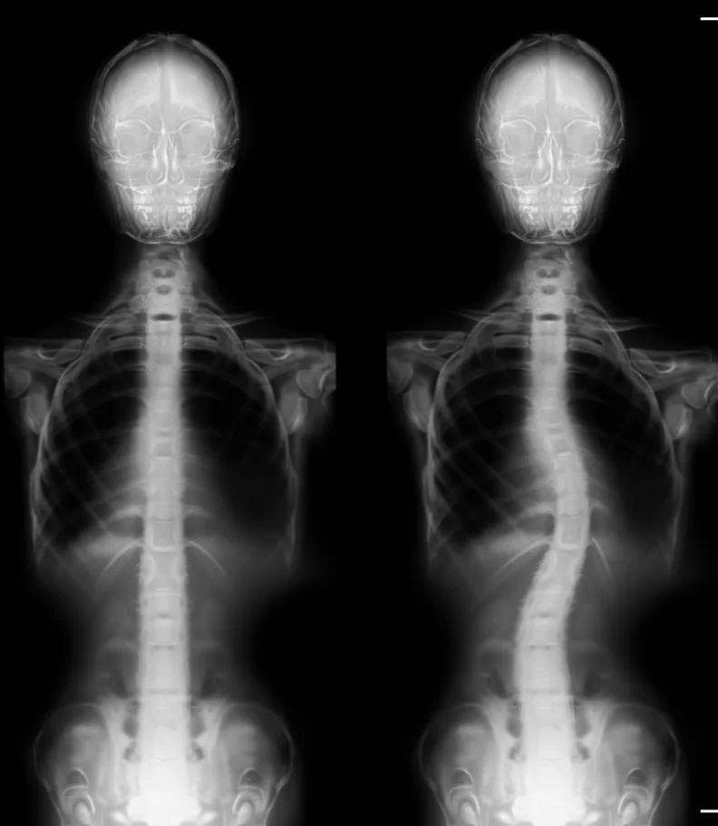 scoliosis Fruitland ID